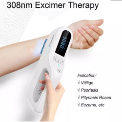 Psoriazės vitiligo psoriazės egzemos grybelinės mikozės eksimerinis 308nm lazeris UV lempa