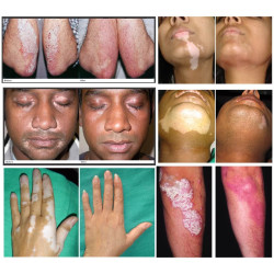 Psoriazės vitiligo psoriazės egzemos grybelinės mikozės eksimerinis 308nm lazeris UV lempa