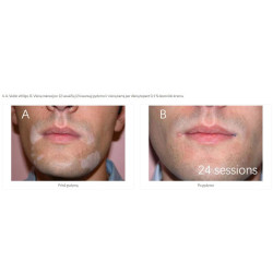 Excimer 308 nm lazeris