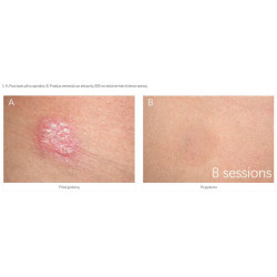 Excimer 308 nm lazeris