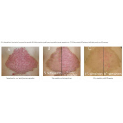 Excimer 308 nm lazeris