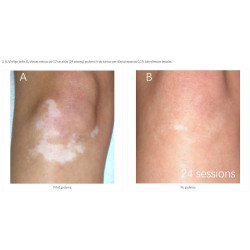 Excimer 308 nm lazeris