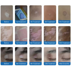 Excimer 308 nm lazeris