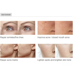 Veido odos atjauninimo RF prietaisas