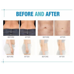 Kavitacijos Vakuumo RF Lazerio aparatas