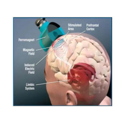 Transkranijinis magnetinis smegenų stimuliatorius