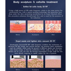 Vakuuminis RF veido ir kūno priežiūros aparatas