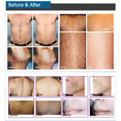 Epiliacijos Diodo 808 Nd Yag Lazeris