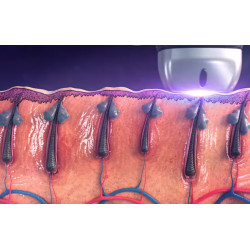 Epiliacijos Titanium diodo lazeris SHR 808 nm