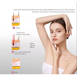 Epiliacijos Titanium diodo lazeris SHR 808 nm