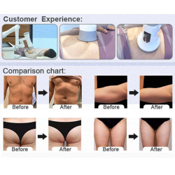 Robotas kūno formavimui EMS CRYO