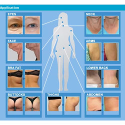 Exili ultra 360 RF veido liftingas kūno lieknėjimo aparatas