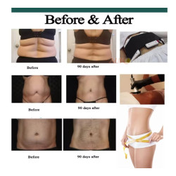 Vakuumo Kavitacijos RF Lazerio kūno lieknėjimo įranga