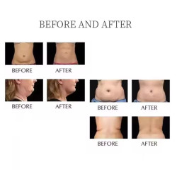 Vakuumo Kavitacijos RF Lazerio kūno lieknėjimo įranga