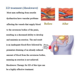 Smūginės, vibracinės bangos terapijos aparatas