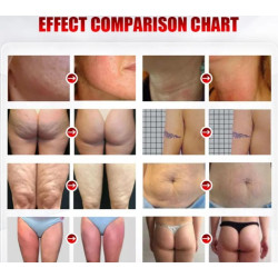 Velashape Vakuuminis RF lieknėjimo aparatas