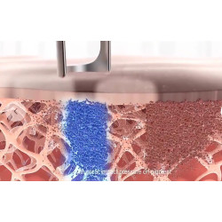 ND YAG pikosekundinis tatuiruočių šalinimo lazeris