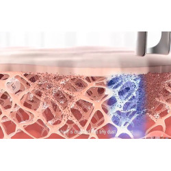 ND YAG pikosekundinis tatuiruočių šalinimo lazeris