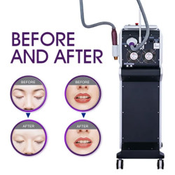 ND YAG pikosekundinis tatuiruočių šalinimo lazeris