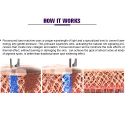 ND YAG pikosekundinis tatuiruočių šalinimo lazeris