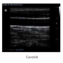Mindray skaitmeninis ultragarso aparatas