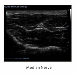 Mindray skaitmeninis ultragarso aparatas