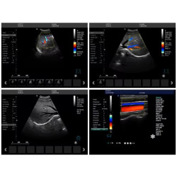 Doplerio ultragarso aparatas skirtas akušeriniams matavimams spalvotas