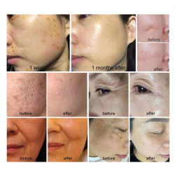 Plasma 9in1 plazmos aparatas veidui, kūnui