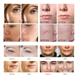 Plasma 9in1 plazmos aparatas veidui, kūnui