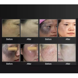 Pico ND YAG lazeris + 808 diodinis lazeris