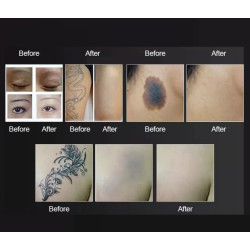 Pico ND YAG lazeris + 808 diodinis lazeris