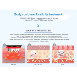 Kavitacijos  RF BIO Lazerio aparatas