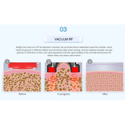 Kavitacijos  RF BIO Lazerio aparatas