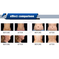 Kavitacijos Vakuumo RF aparatas