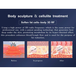 Vakuumo kavitacijos RF fizinės terapijos įranga 3 in 1