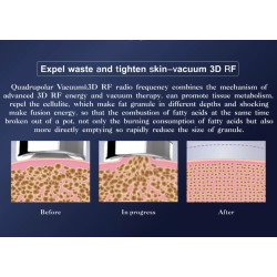 Vakuumo kavitacijos RF fizinės terapijos įranga 3 in 1